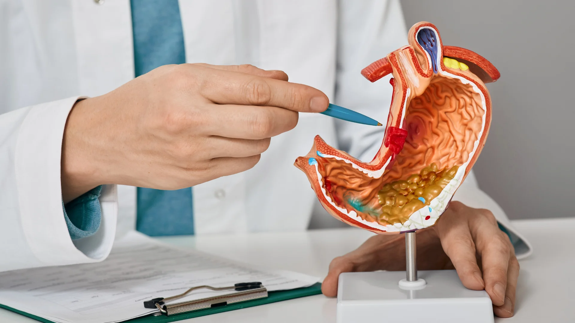 Peptic Ulcers